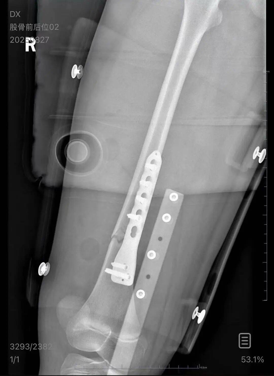 男子火车上铺跌落砸断10岁女孩腿骨,回应“失联”称失业讨薪中