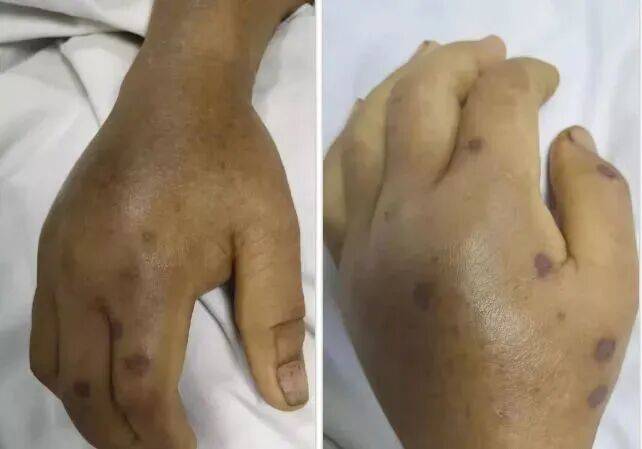 深圳一市民突遭马蜂围袭!已进入高发期,千万别招惹!